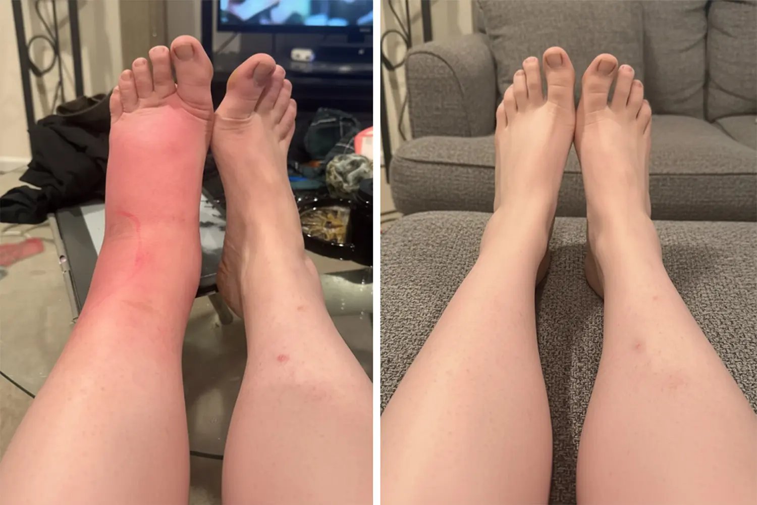 Swollen legs and feet